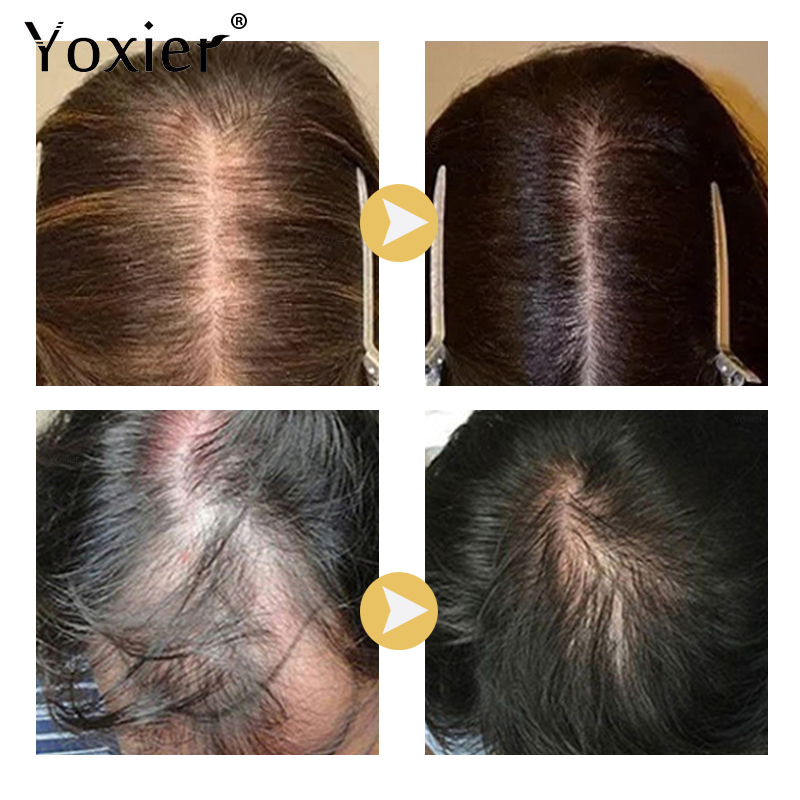Chuyên Sâu Serum Kích Kem Ngăn - đánh giá và giá Hair Care For Hair Loss